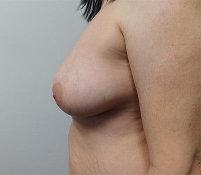 Before Image: Breast Lift - other