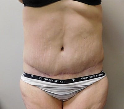 After Image: Abdominoplasty - front