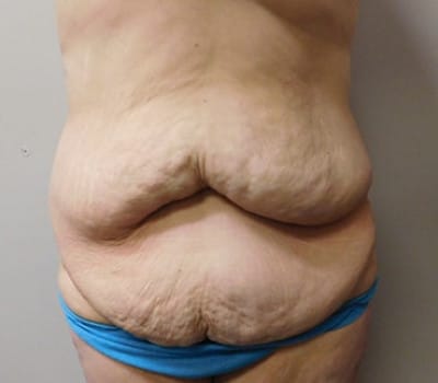 Before Image: Abdominoplasty - front