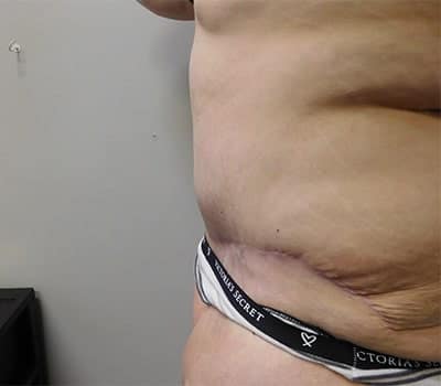 After Image: Abdominoplasty - other