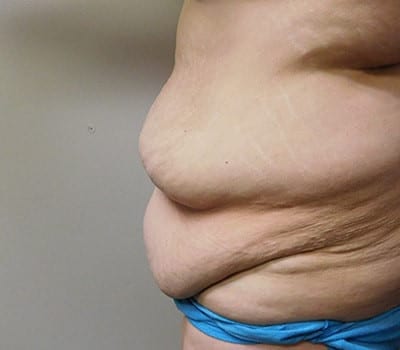 Before Image: Abdominoplasty - other