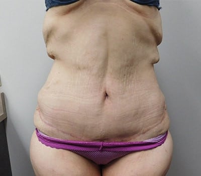 After Image: Abdominoplasty - front