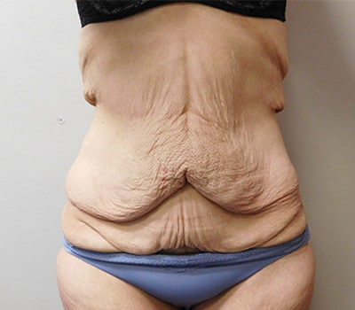 Before Image: Abdominoplasty - front