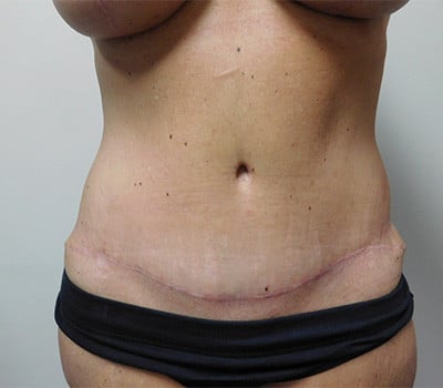 After Image: Abdominoplasty - front