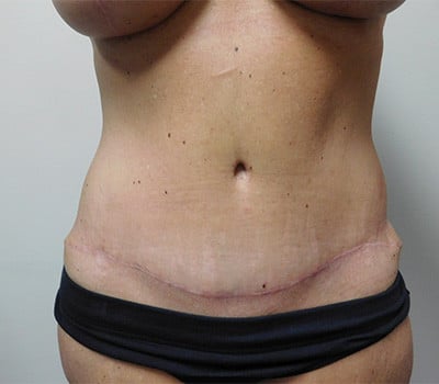 Abdominoplasty