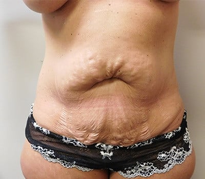 Before Image: Abdominoplasty - front