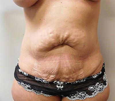 Abdominoplasty