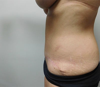 After Image: Abdominoplasty - other