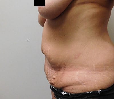 Before Image: Abdominoplasty - other