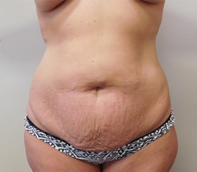 Before Image: Abdominoplasty - front