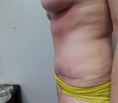 After Image: Abdominoplasty - other