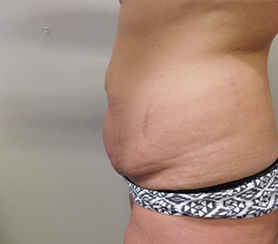Before Image: Abdominoplasty - other