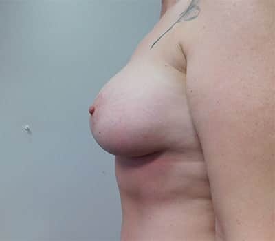 After Image: Breast Augmentation with Lift - other