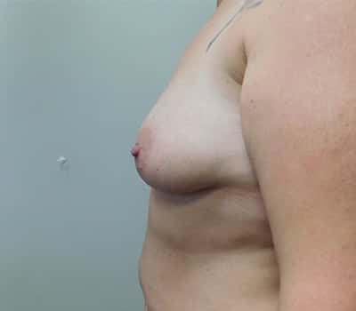 Before Image: Breast Augmentation with Lift - other