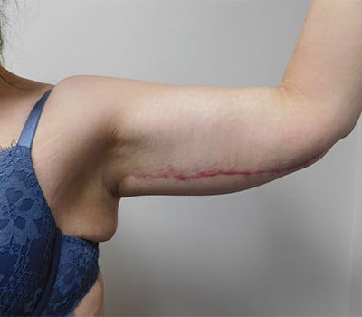 After Image: Brachioplasty - other