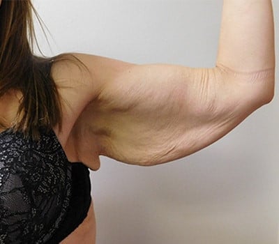 Before Image: Brachioplasty - other