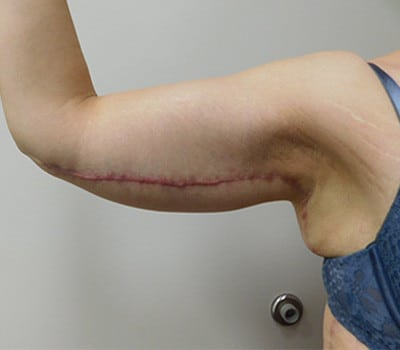 After Image: Brachioplasty - other
