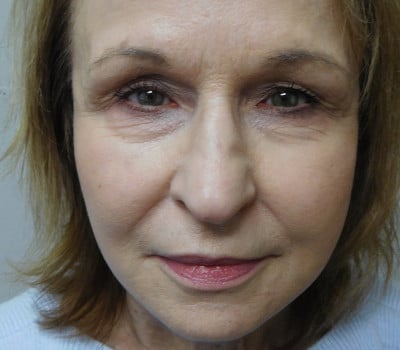 After Image: Facelift - front