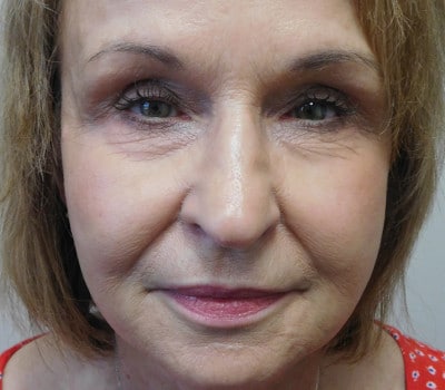 Before Image: Facelift - front