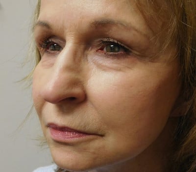 After Image: Facelift - left-front-oblique