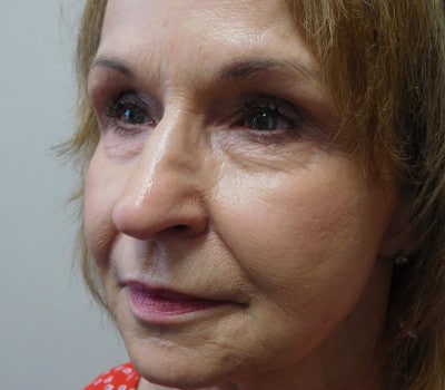 Before Image: Facelift - left-front-oblique