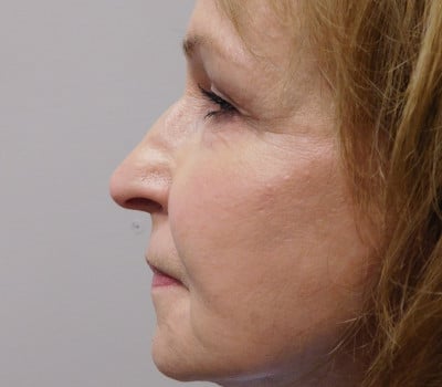 After Image: Facelift - other