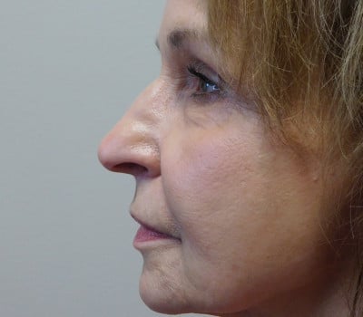 Before Image: Facelift - other