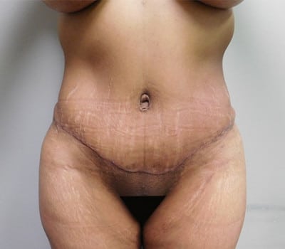 After Image: Abdominoplasty - front