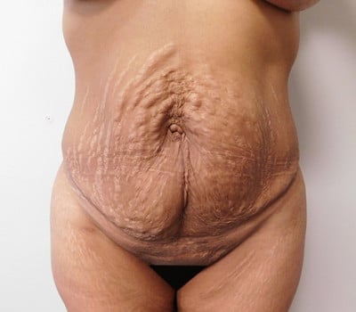 Before Image: Abdominoplasty - front