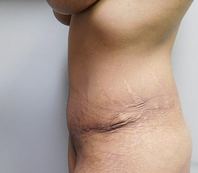After Image: Abdominoplasty - other