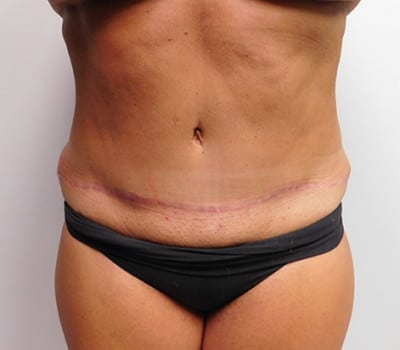 After Image: Abdominoplasty - front