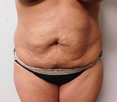 Before Image: Abdominoplasty - front
