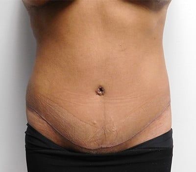 After Image: Abdominoplasty - front
