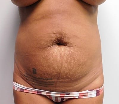Before Image: Abdominoplasty - front