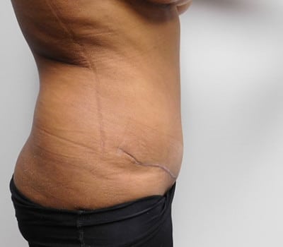 After Image: Abdominoplasty - other