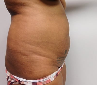 Before Image: Abdominoplasty - other