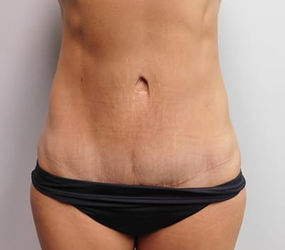 After Image: Abdominoplasty - front