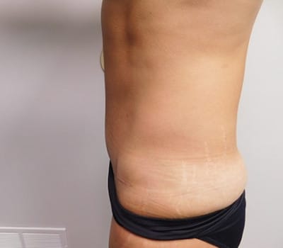 After Image: Abdominoplasty - other