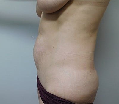 Before Image: Abdominoplasty - other