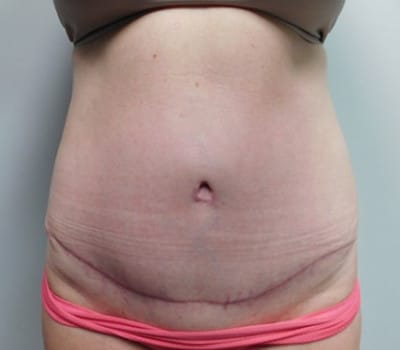 After Image: Abdominoplasty - front