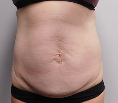 Before Image: Abdominoplasty - front