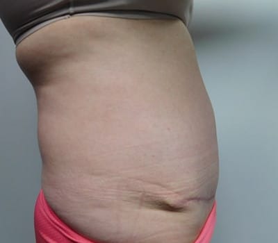 After Image: Abdominoplasty - other