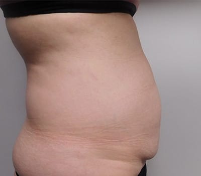 Before Image: Abdominoplasty - other