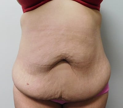 Before Image: Abdominoplasty - front