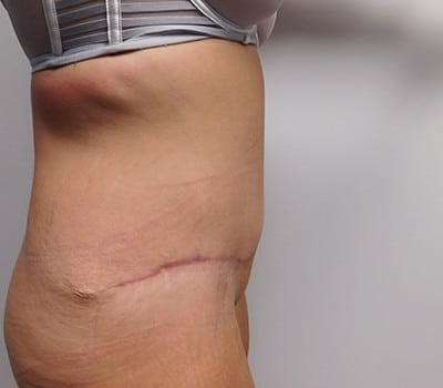 After Image: Abdominoplasty - other