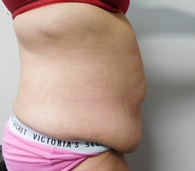 Before Image: Abdominoplasty - other