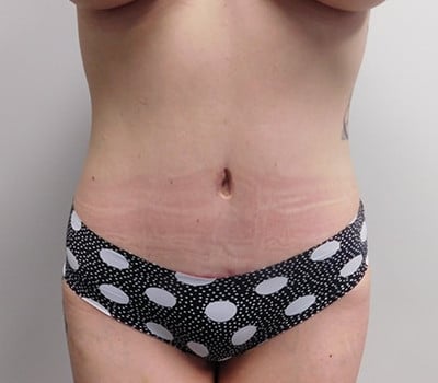After Image: Abdominoplasty - front