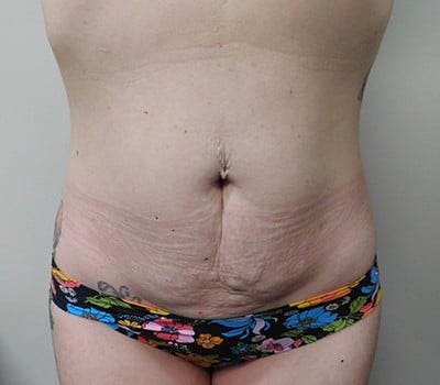 Before Image: Abdominoplasty - front