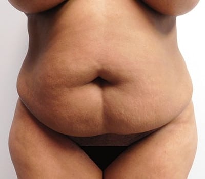 Before Image: Abdominoplasty - front