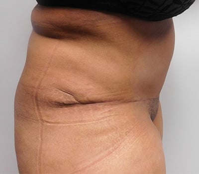After Image: Abdominoplasty - other